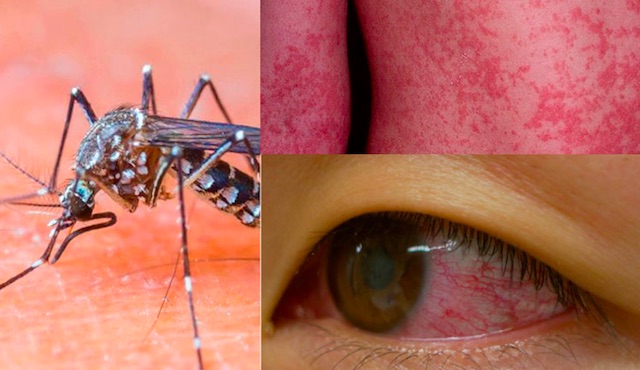 Zika virus, ancora una minaccia dalla zanzara tigre